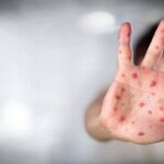 Alerta en África con nueva cepa del virus mpox